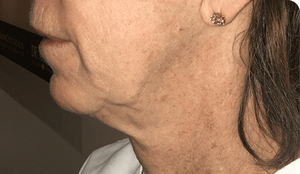 Morpheus8 treatment - after