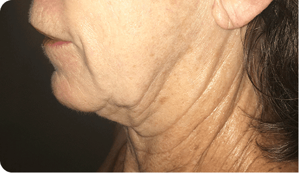 Morpheus8 treatment - before