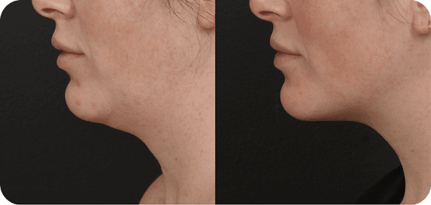 Sofwave treatment results showing neck and jawline improvement - before and after comparison