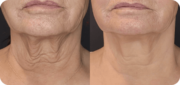 Sofwave treatment results showing facial skin tightening - before and after comparison