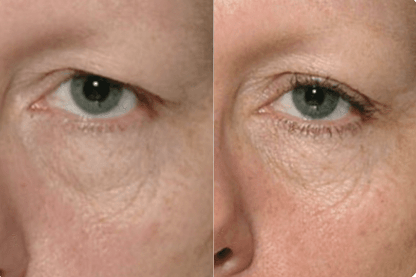 Thermage FLX treatment results - before and after comparison