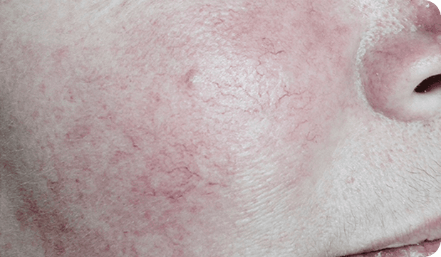 After Lumecca treatment