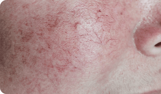 Before Lumecca treatment