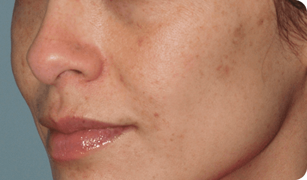 After pigmentation removal treatment