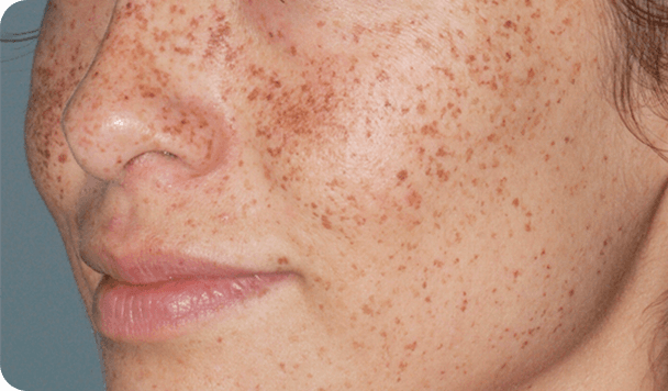 Before pigmentation removal treatment